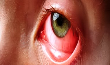 मानसूनी बारिश से आंखों में हो रहा संक्रमण, बचाव जरूरी