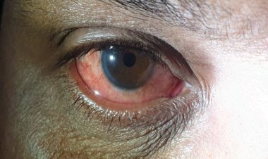 उत्तर भारत में बढ़ी आई फ्लू के मरीजों की संख्या